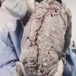 Baby born with an DIU peg…
