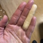 Genit@l Skin Changes: When to Worry and When to Relax