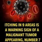 Itching in 9 Areas: A Warning Sign of Malignant Tumors, Number 7 Is the Most Common