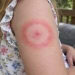 AN. The Red Ring of Terror: Is Your Child’s Mysterious Rash a Harmless Bug Bite or a Life-Changing Diagnosis?